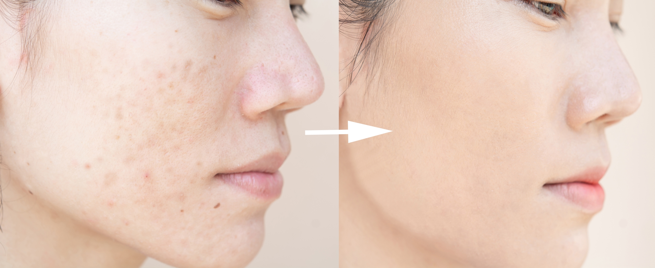 本頁圖片/檔案 - pico-before-after-acne