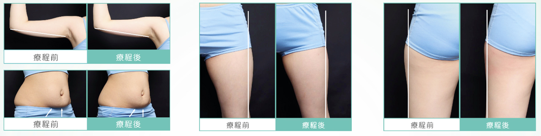 本頁圖片/檔案 - BTL-beforeafter-body